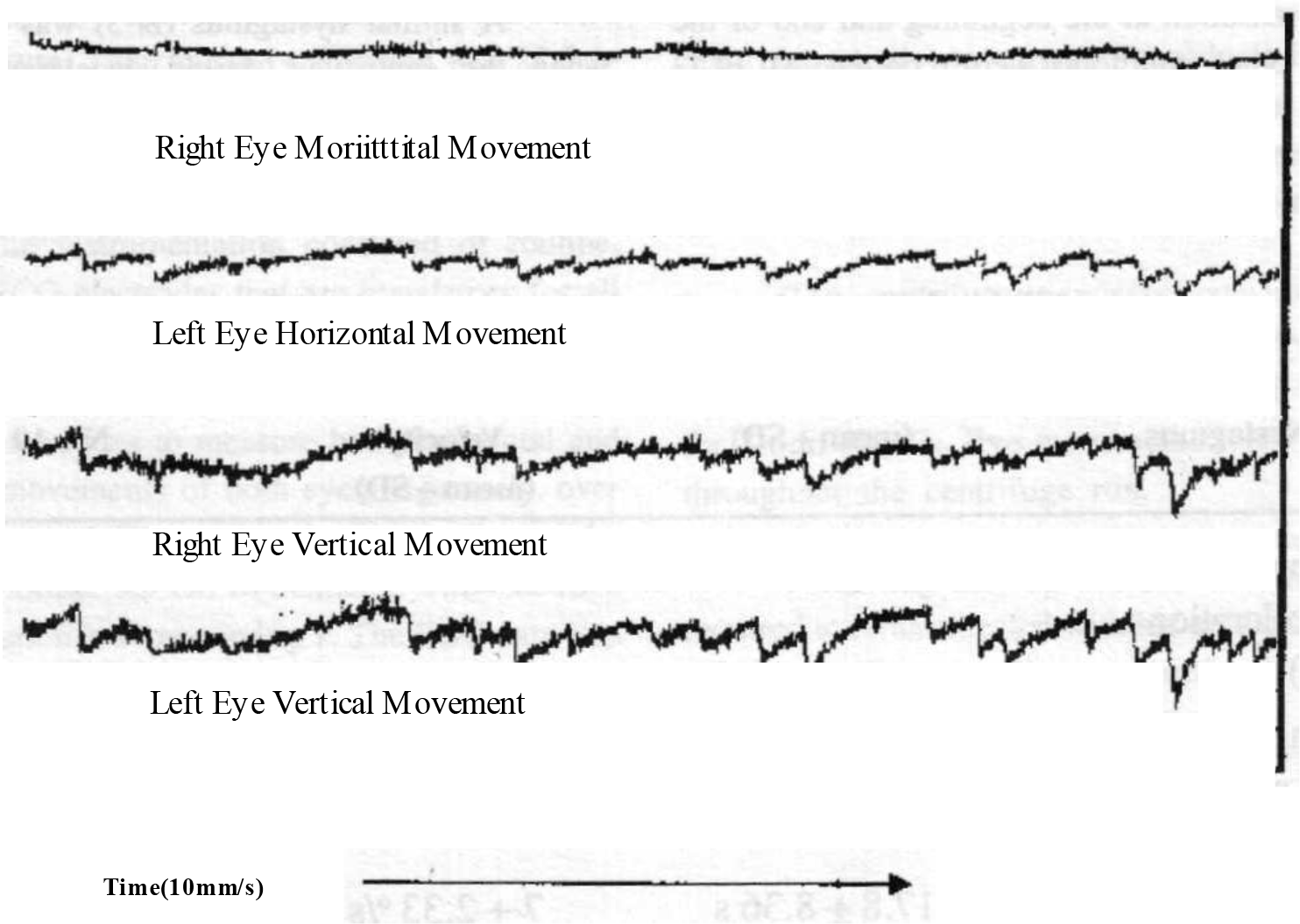 Tracing showing intermittent nystagmus Note : Tracing shows both eyes moving simultaneously. The movement is predominantly vertical with a slight horizontal component. The amplitude, frequency and slow phase velocity of the nystagmus changes with time.