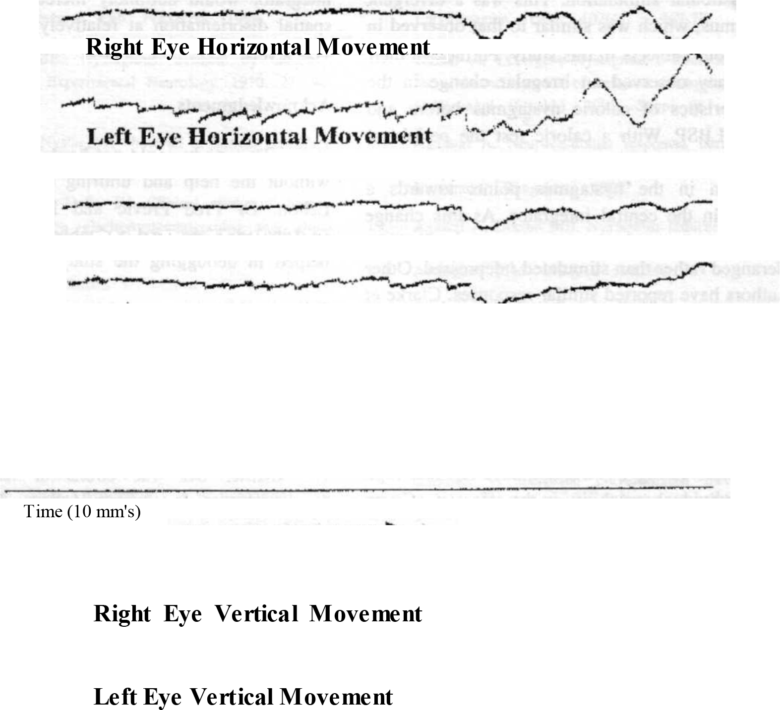 Tracing showing dissociation Note : Tracing showing dissociation of the two eyes. The left eye is showing a predominantly horizontal nystagmus, while the right eye remains stationary. It is noteworthy that both eyes show a slow drifting movement together, indicating that the system is functioning properly.