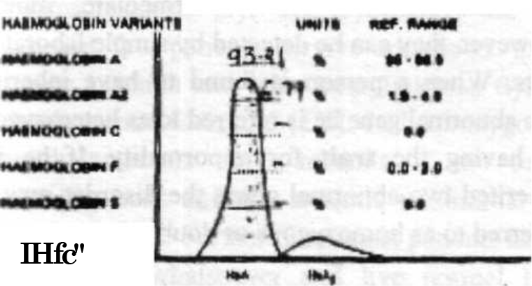 Electrophoresis of Subject No 2