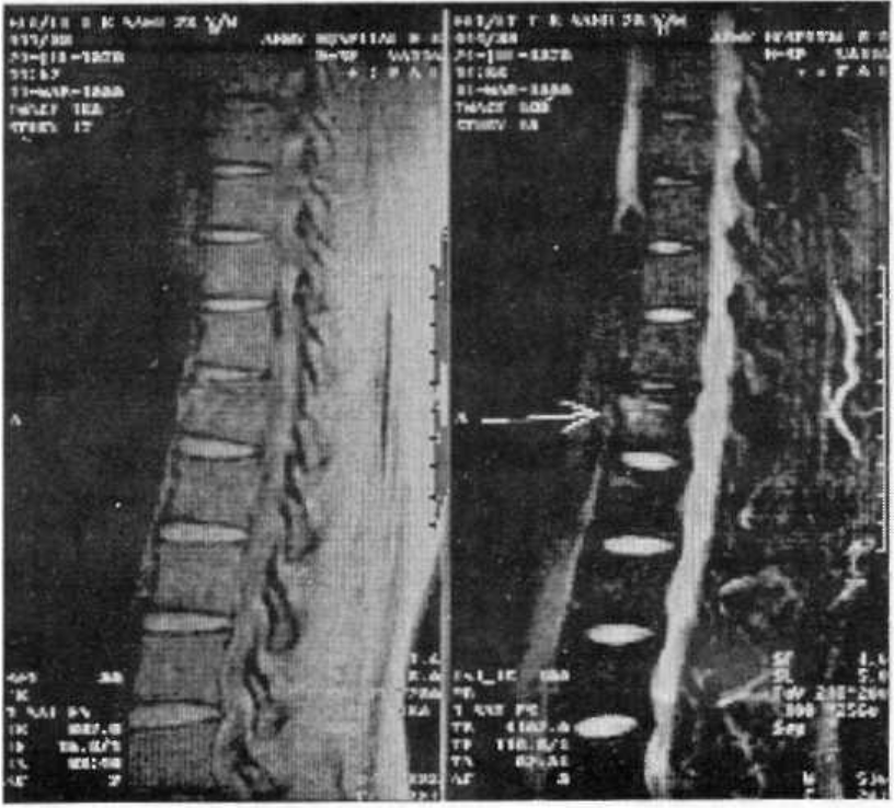 MRI - Fractures DV 12