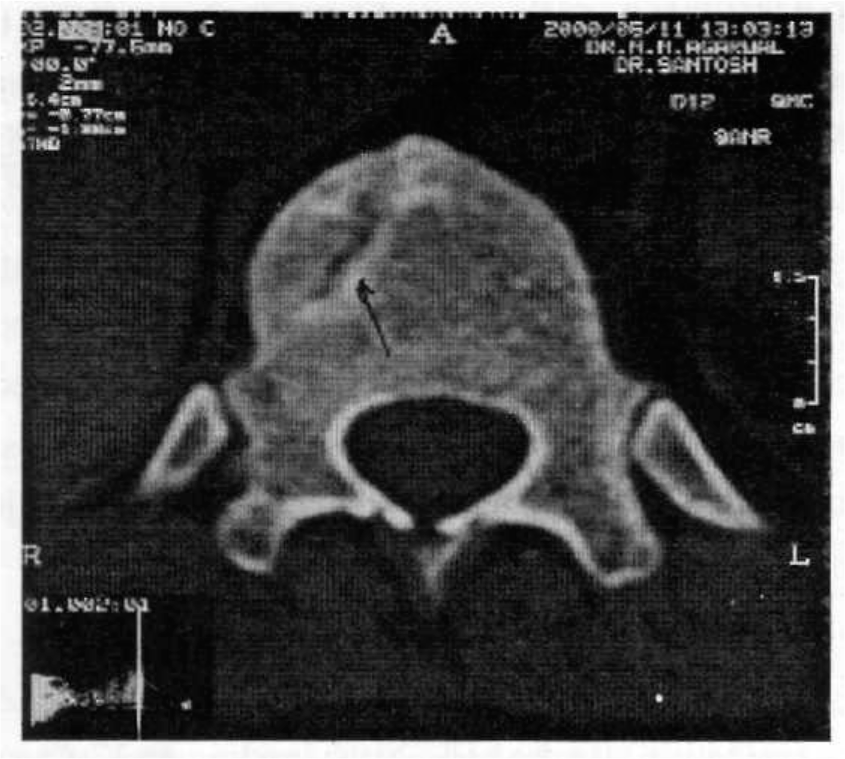 CT - Fracture DV 12