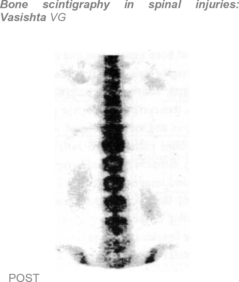 Bone Scan - Hot Area DV 12