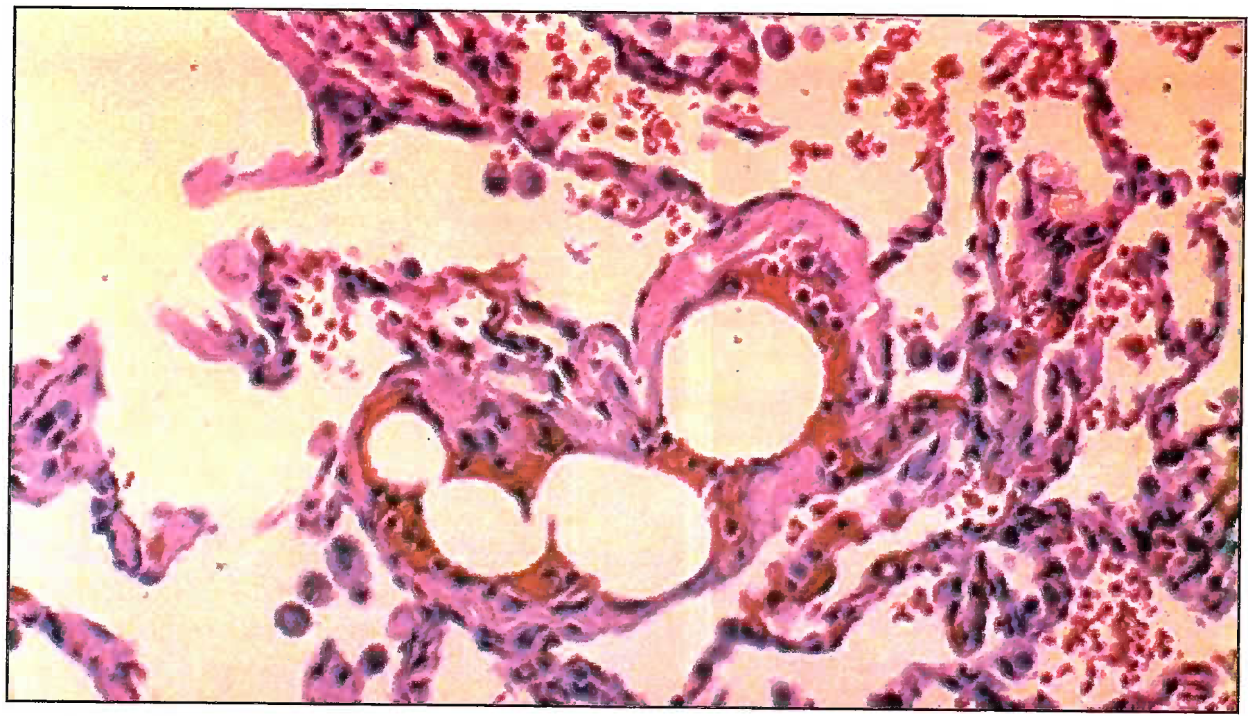 Microphotograph showing fat emboli in pulmonary vessel (400X) Grade II