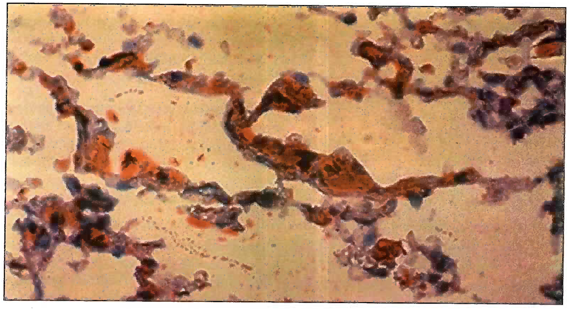 Sudan Black III Stain Microphotograph showing fat emboli in pulmonary vessel (400X) Grade III