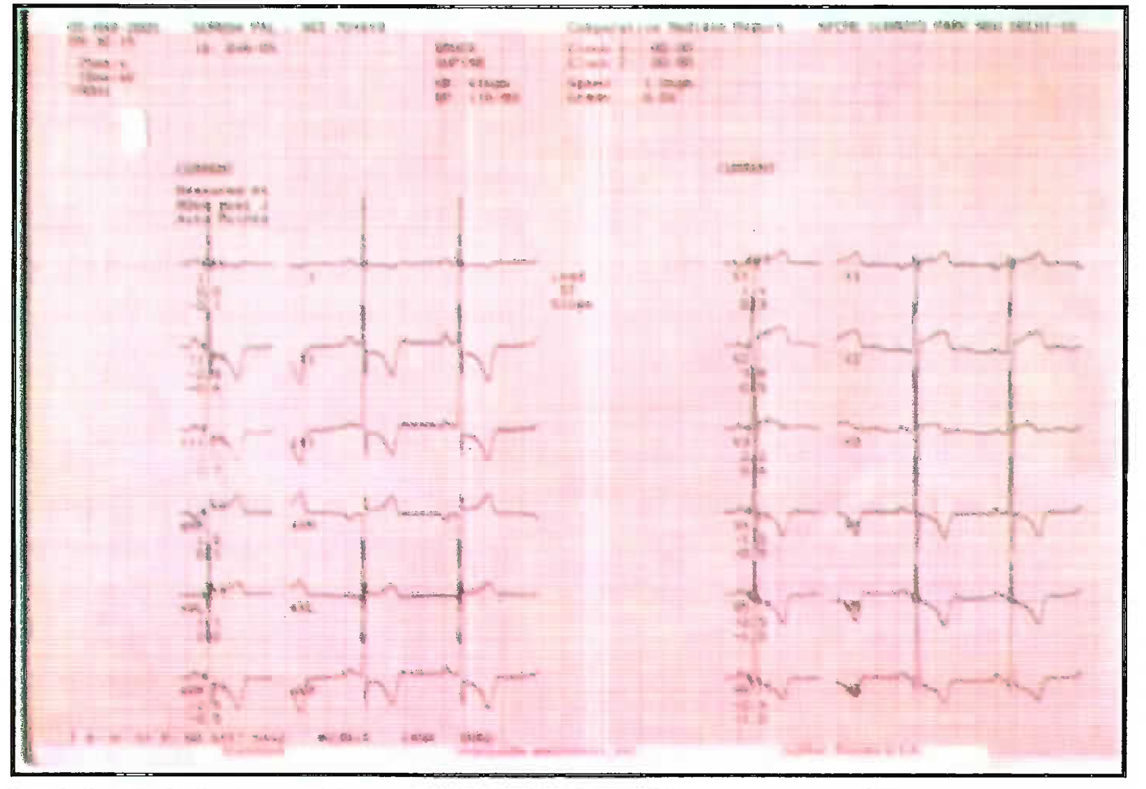 12-lead ECG from a 36 year-old mile showed marked and diffuse T wave inversion (up to 7 mm to depth) in lateral precordial (V4 to V6) and irferior leads (II, III and aVF), increased R wave voltage >30 mm (V4-Vs).