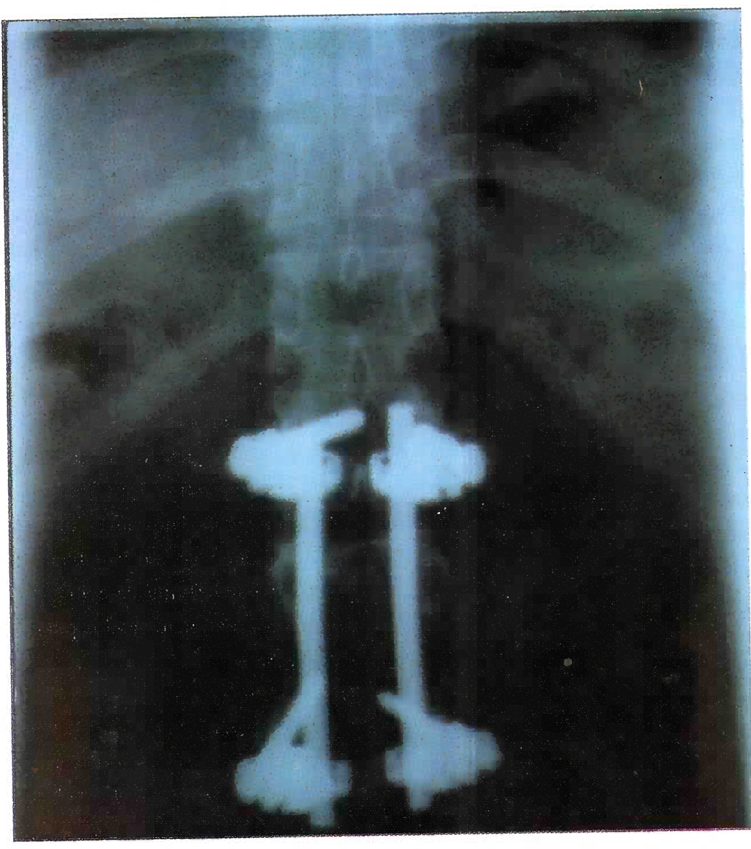 X-ray showing implant in-situ