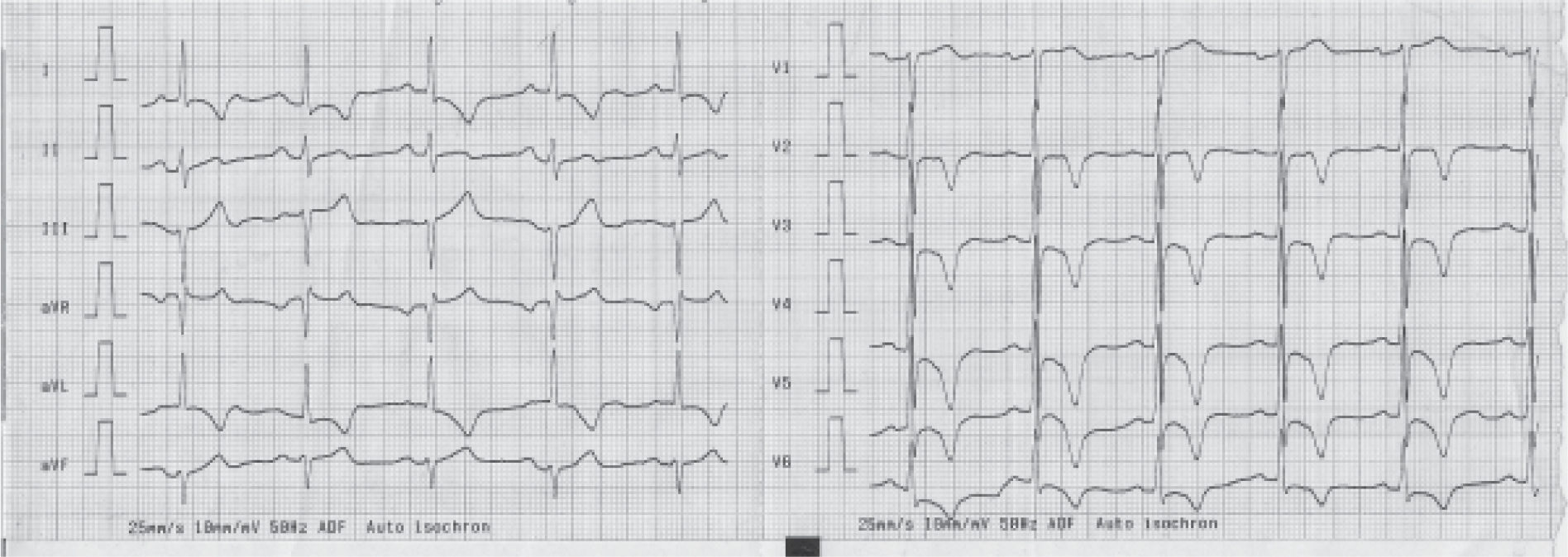 An ECG of an candidate for civil aircrew duties