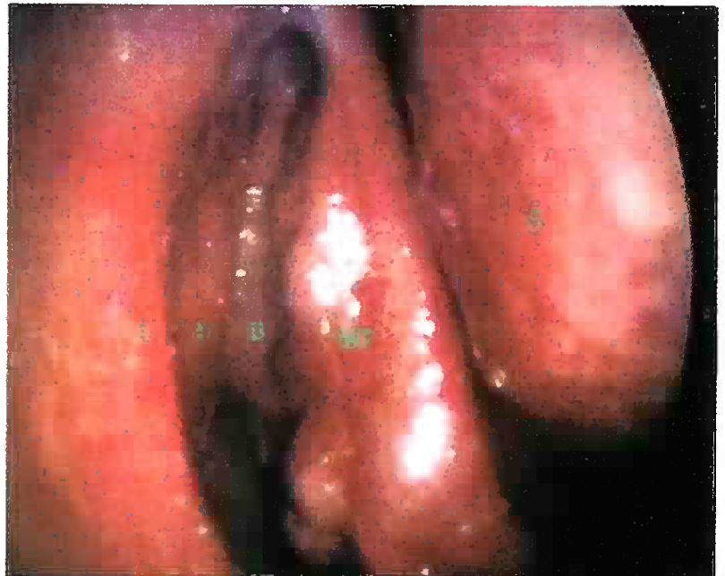 Normal Endoscopic view of Right Nasal Cavity