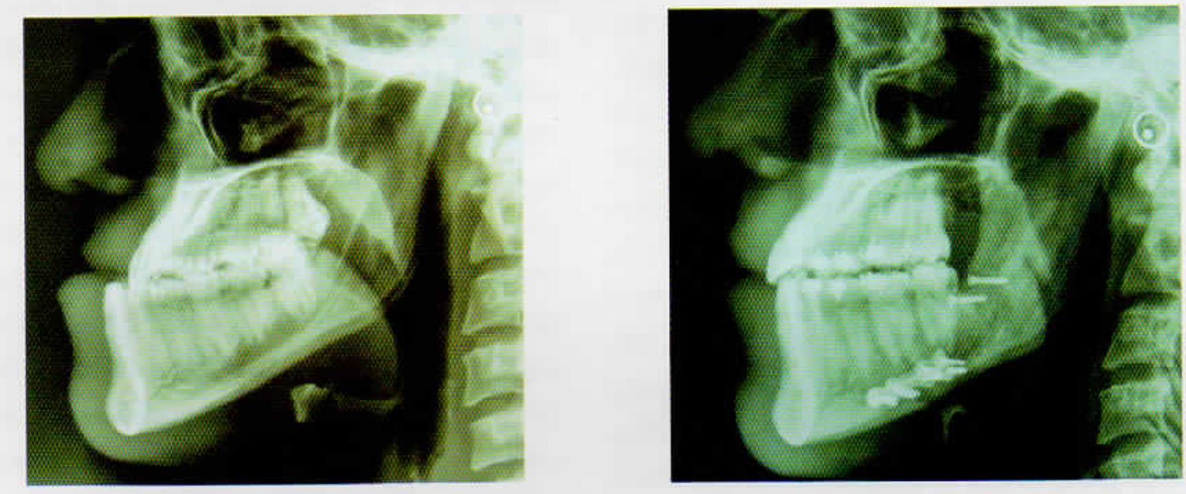 Pre & Post-Operative Cephalogram