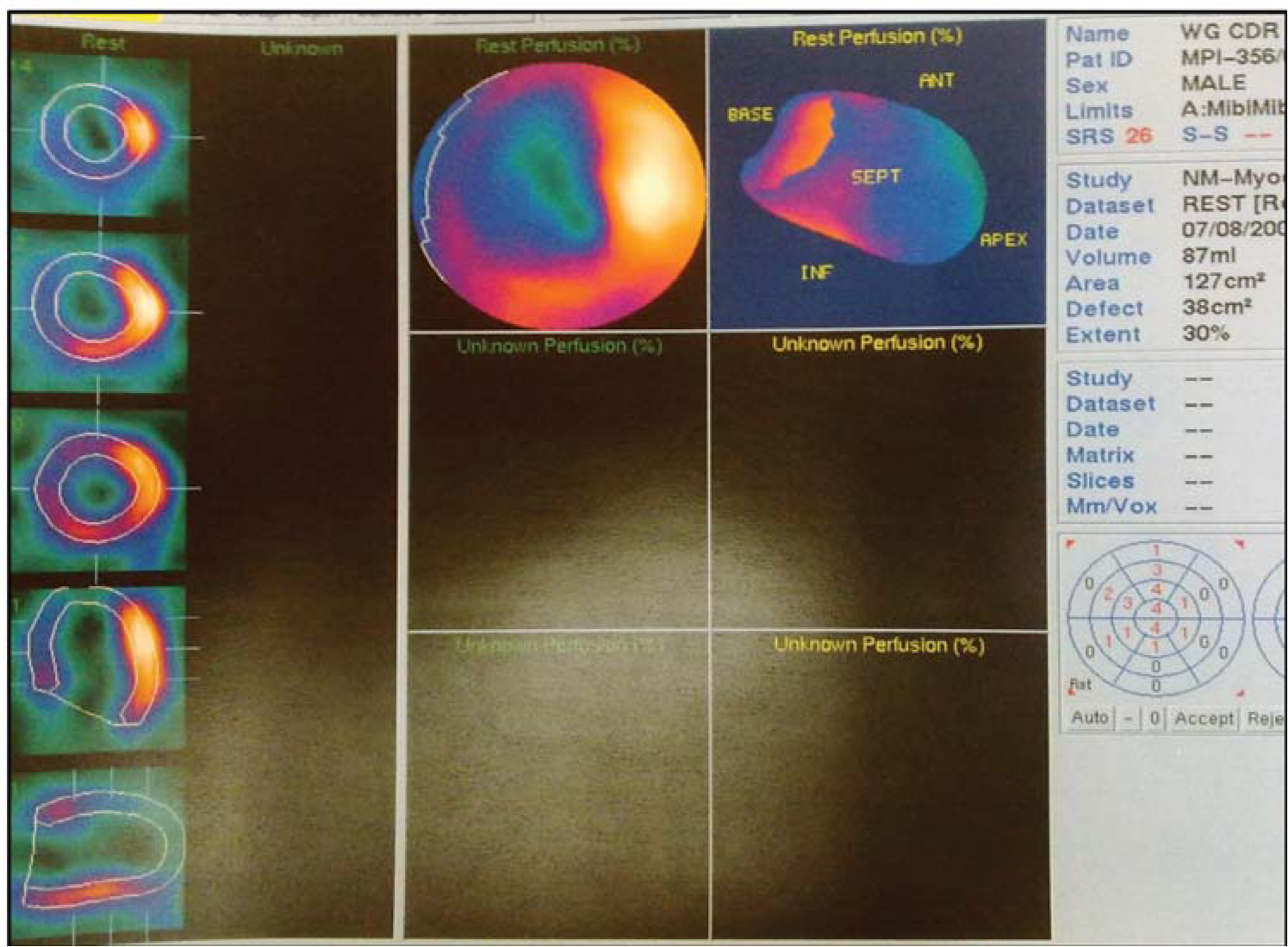 Resting MPI study done immediately after primary PTCA. Bull’s eye image showing a large perfusion defect in the LAD territory with resting score of 26 and extent of 30%.