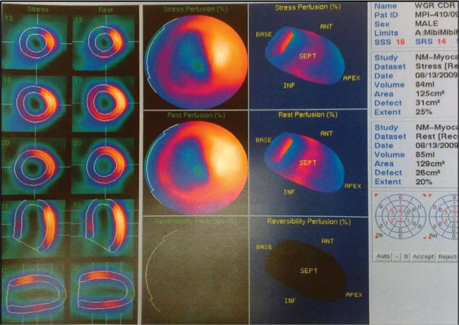 Stress MPI study of the same patient (Fig-1) after 6months showing decrease in size of perfusion defect with score of 14 and extent of 20%.