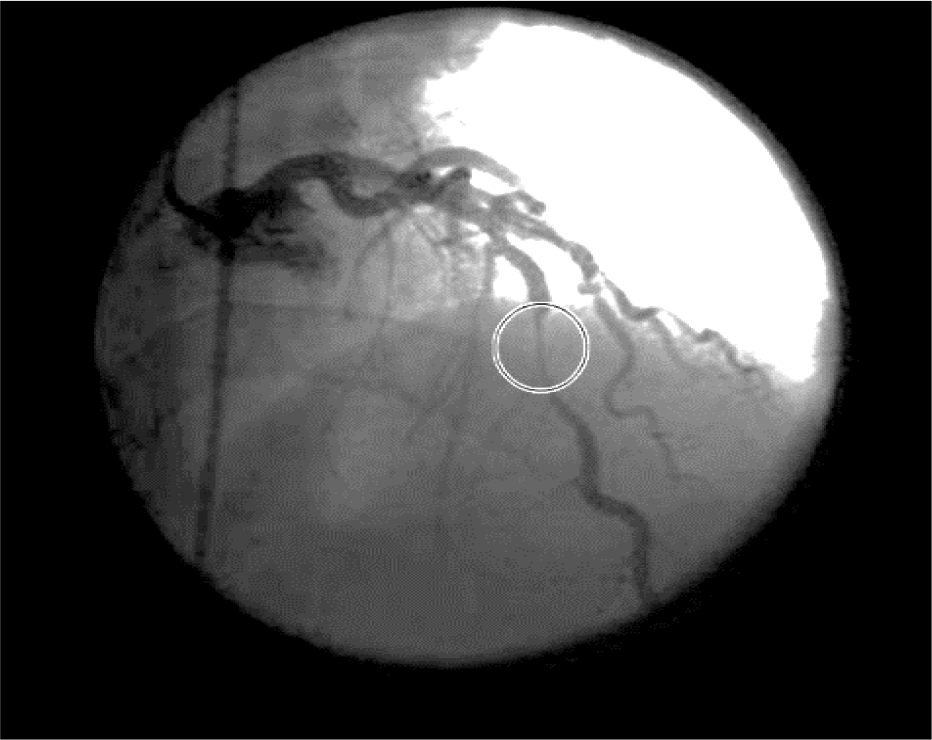 CAG showing mid myocardial bridge in LAD