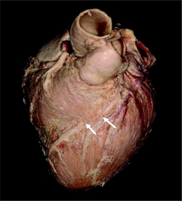 Representational view-myocardial bridge in LAD