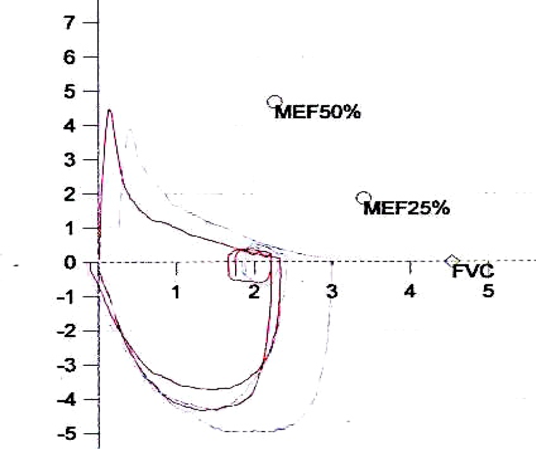 Flow-Volume Loop