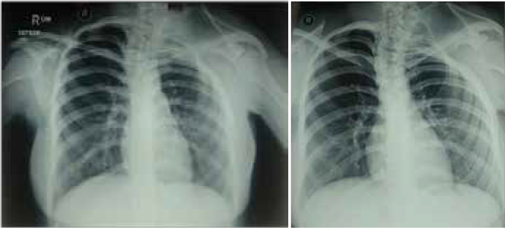 AP views of Chest X-ray showing Elevated Scapula (Left), Dextroscoliosis and Hypoplastic ribs