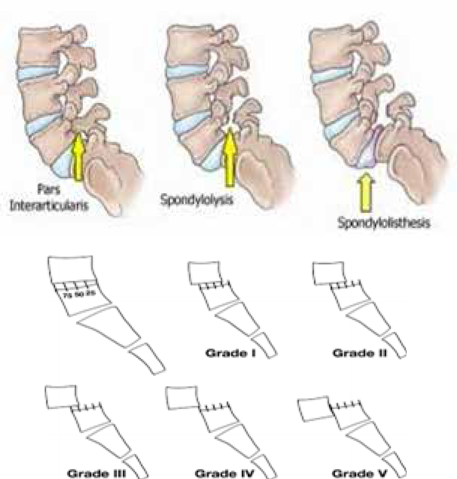 spondylolisthesis grades