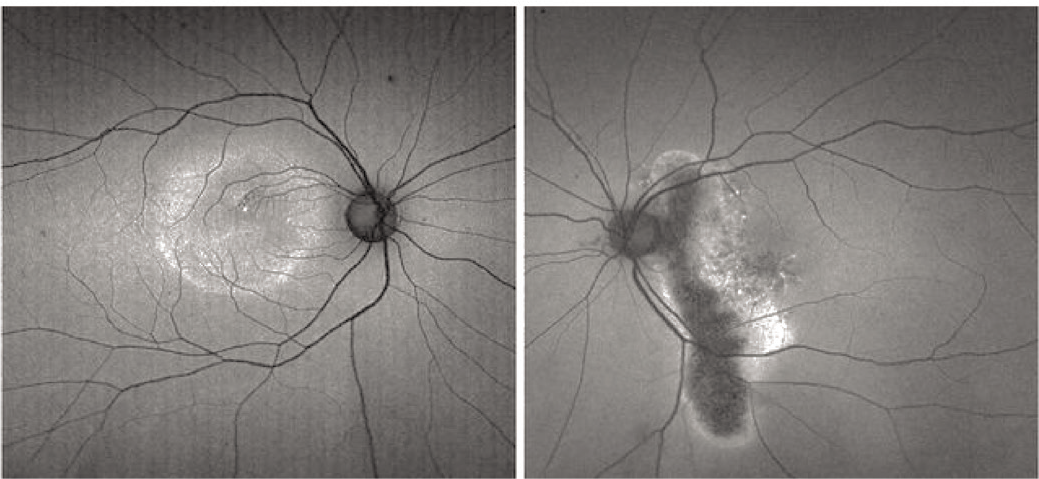 Acute CSCR with visual field loss