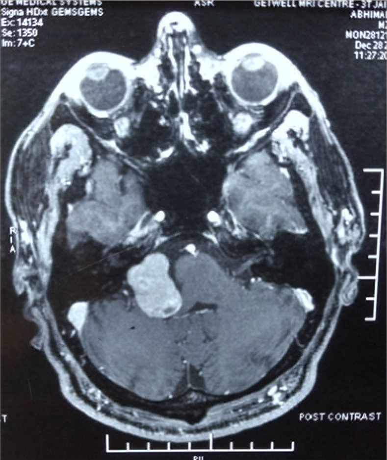 Pre-operative post contrast MR Image of the tumour (Type D) at Cerebello-pontine angle epicentered in the Right Jugular Foramen.