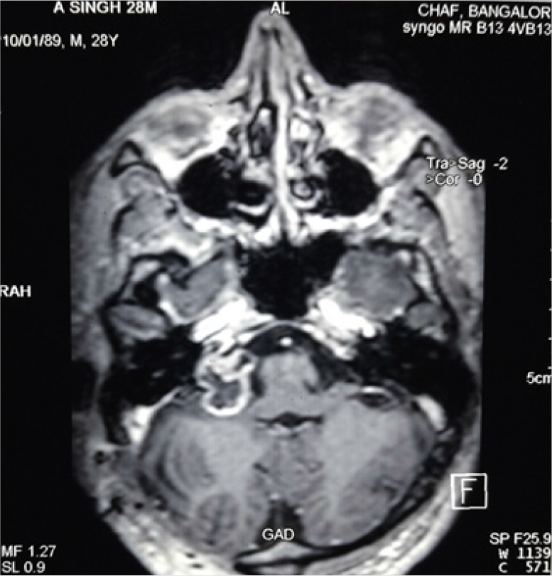 Contrast enhanced image of remaining tumour mass post Stereotactic Radio-Surgery.