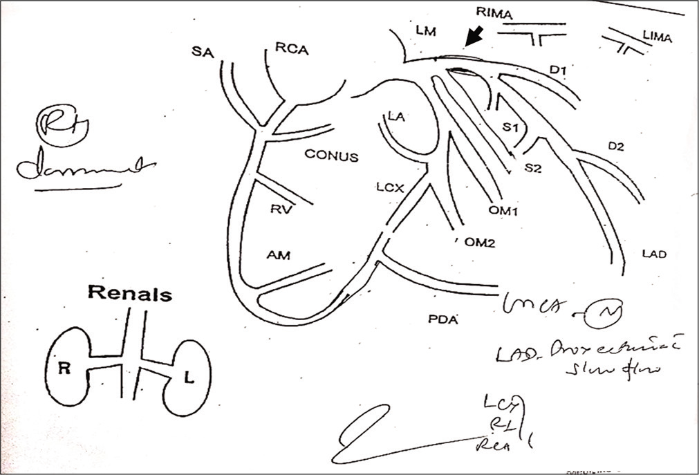 Coronary angiography showing proximal ectasia.