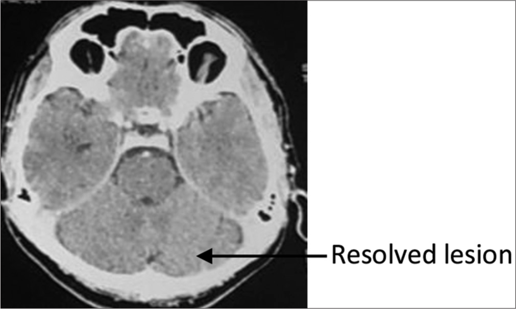 Contrast-enhanced computed tomography brain April 2021.