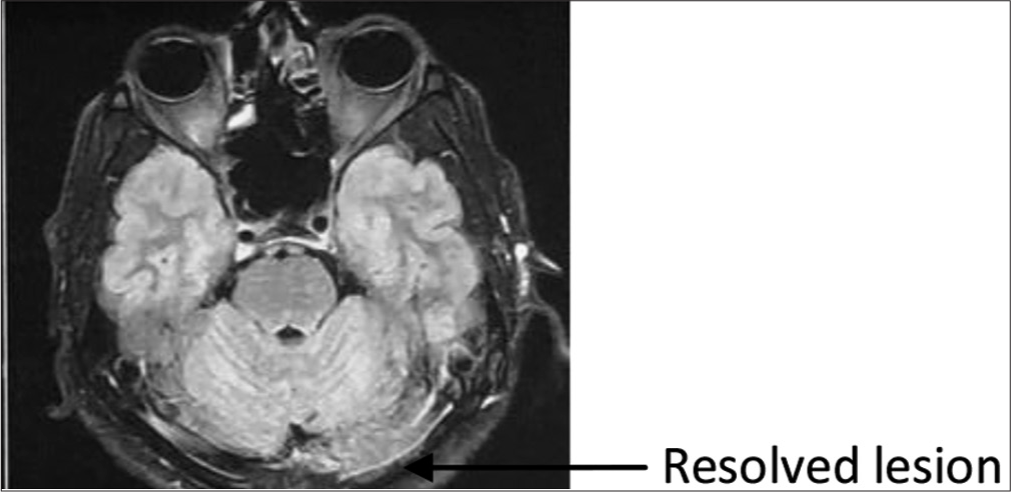 Magnetic resonance imaging brain July 2022