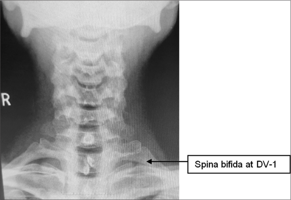 X-ray cervicodorsal spine.