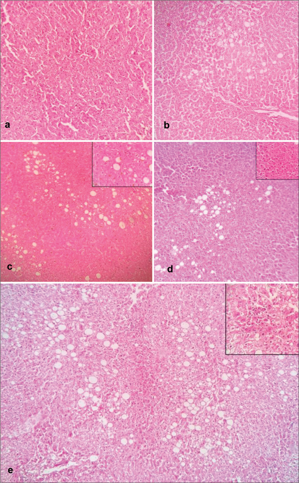 Photomicrographs illustrating different non-alcoholic fatty liver disease activity scores (NAS) (Hematoxylin and Eosin stain, ×10). The inset images show inflammation (×40). (a) NAS-0 (<5% steatosis); (b) NAS – 1 (steatosis: 1, noinflammation); (c) NAS – 2 (steatosis 1, Inflammation: 1); (d) NAS – 3 (steatosis: 1, inflammation: 2) and (e) NAS – 4 (steatosis: 2, inflammation: 2).